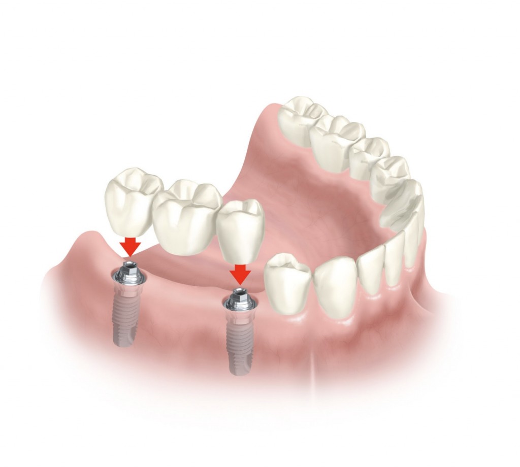 implantes dentales 